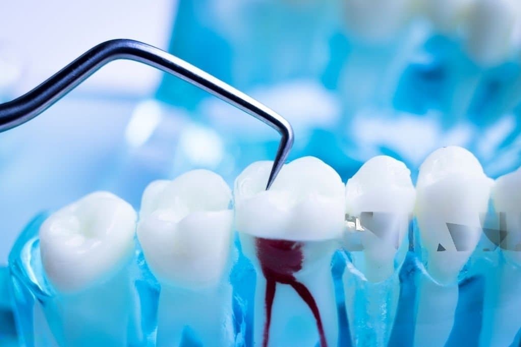 Root Canal Treatment: Restoring Health and Comfort to Your Smile