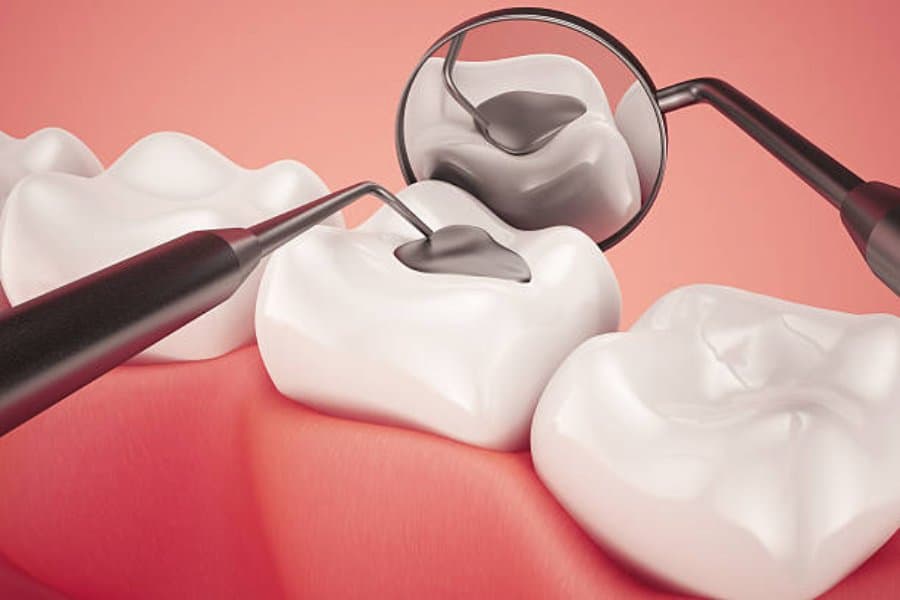 White Fillings: A Modern Solution for Strong, Natural-Looking Restorations