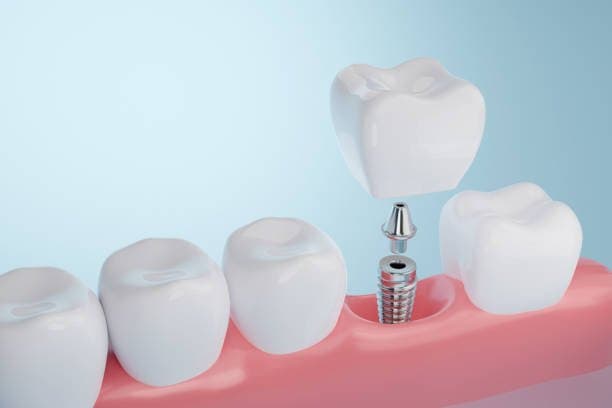 Dental Implants: A Permanent Solution for Missing Teeth