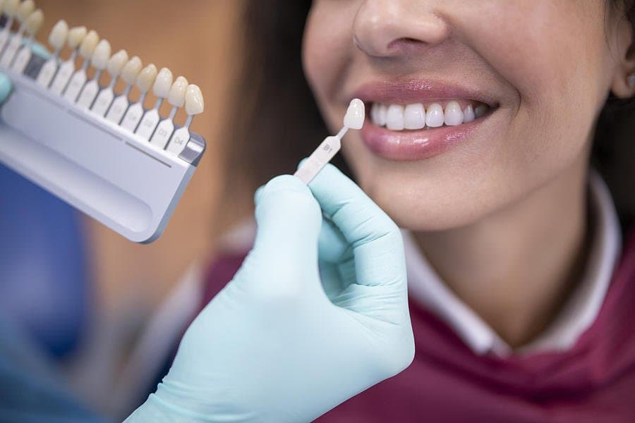 Veneers: Enhancing Your Smile with Confidence