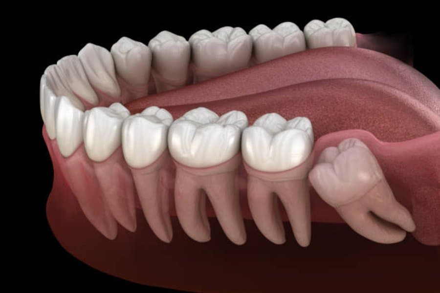 Wisdom Teeth: Understanding the Basics and When Extraction is Necessary
